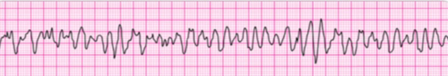 <p>You are monitoring a patient with chest discomfort who suddenly becomes unresponsive. You observe the following rhythm on the cardiac monitor. A defibrillator is present. What is your first action?</p><p>1. Intubate the patient and give epinephrine 2 to 4 mg via the endotracheal tube.</p><p>2. Being CPR with chest compressions for 2 minutes or about 5 cycles of compressions and ventilations.</p><p>3. Establish an IV and give epinephrine 1 mg.</p><p>4. Establish and IV and give vasopressin 40 units.</p><p>5. Give a single shock.</p>