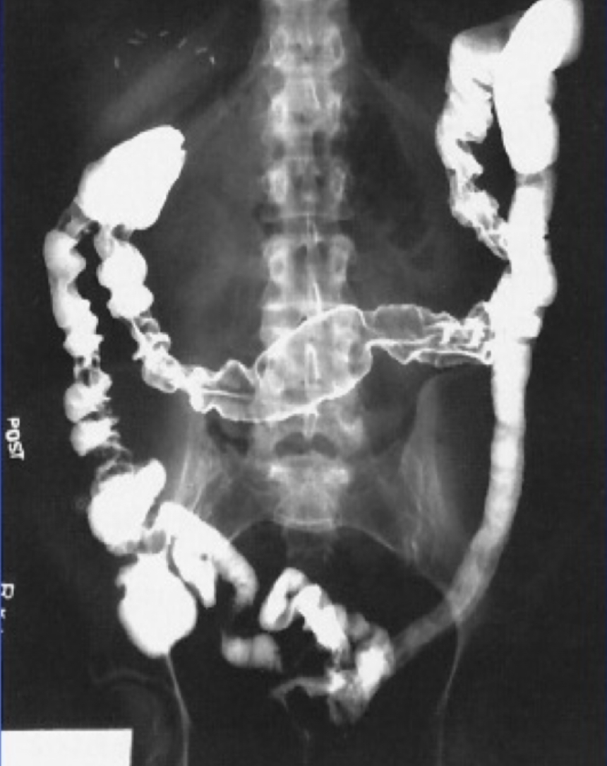 <p>What is this x-ray demonstrating?</p>