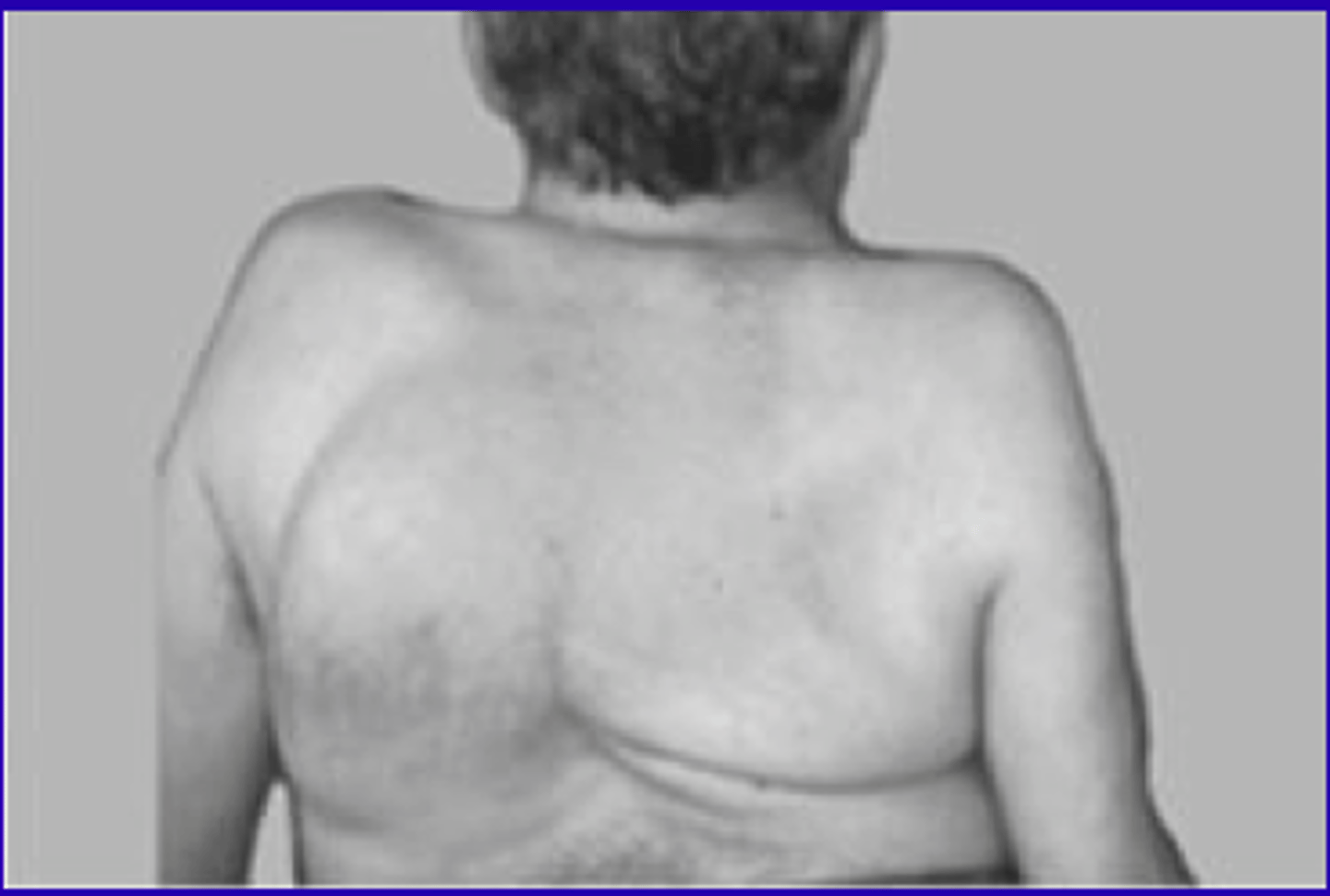 <p>Kyphoscoliosis (kyphosis and scoliosis combined)</p><p>Caused by asymmetric weakening of the para-spinal mucles in e.g., spinal muscle dystrophy </p>