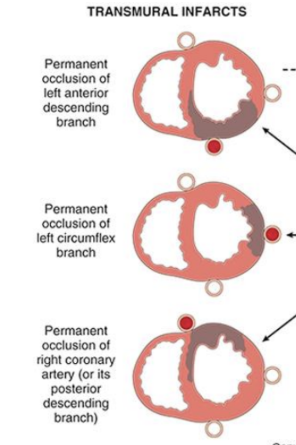 <p>The whole vessel is obstructed</p><p>Occlusion of epicardial vessels</p><p>Necrosis involves full or nearly full thickness of ventricular wall</p><p>(across whole vessel wall)</p>