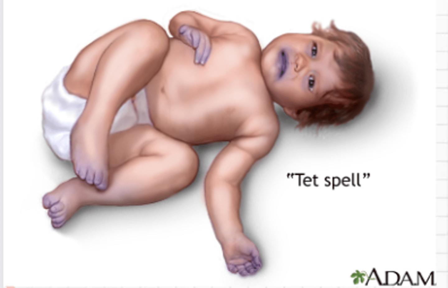 <p>- Some babies with ToF suddenly develops blue or gray, skin, nails and lips.</p><p>- This happens when the baby cries, eats or is upset</p><p>- Due to rapid drop in the amount of oxygen in the blood.</p>