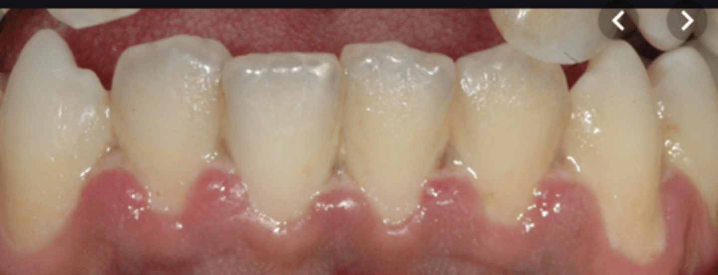 <p>Painful bleeding gums, ulceration and necrosis of interdental papilla - punched out appearance</p>