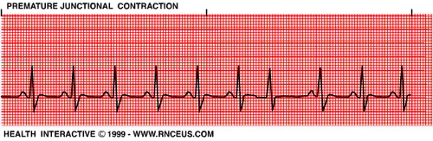 <p>Irritable focus produces an early beat</p><p>Usually followed by a pause</p><p>Similar to PAC</p>