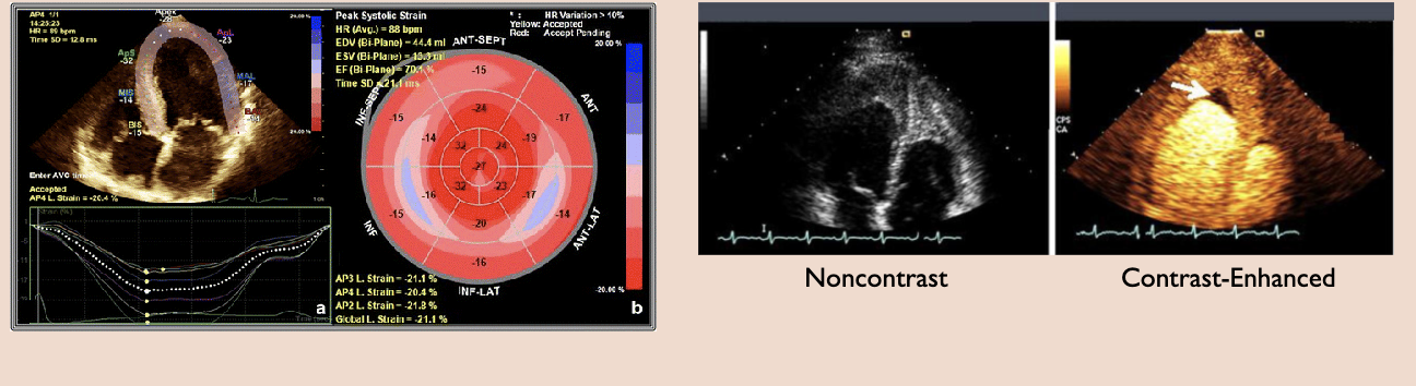 <p>Strain imaging: shows changes in how the heart muscle moves. It can catch early signs of heart disease</p><p>Contrast imaging: A contrast agent is injected into a vein. The contrast agent is visible in the images and can show details of the heart </p>