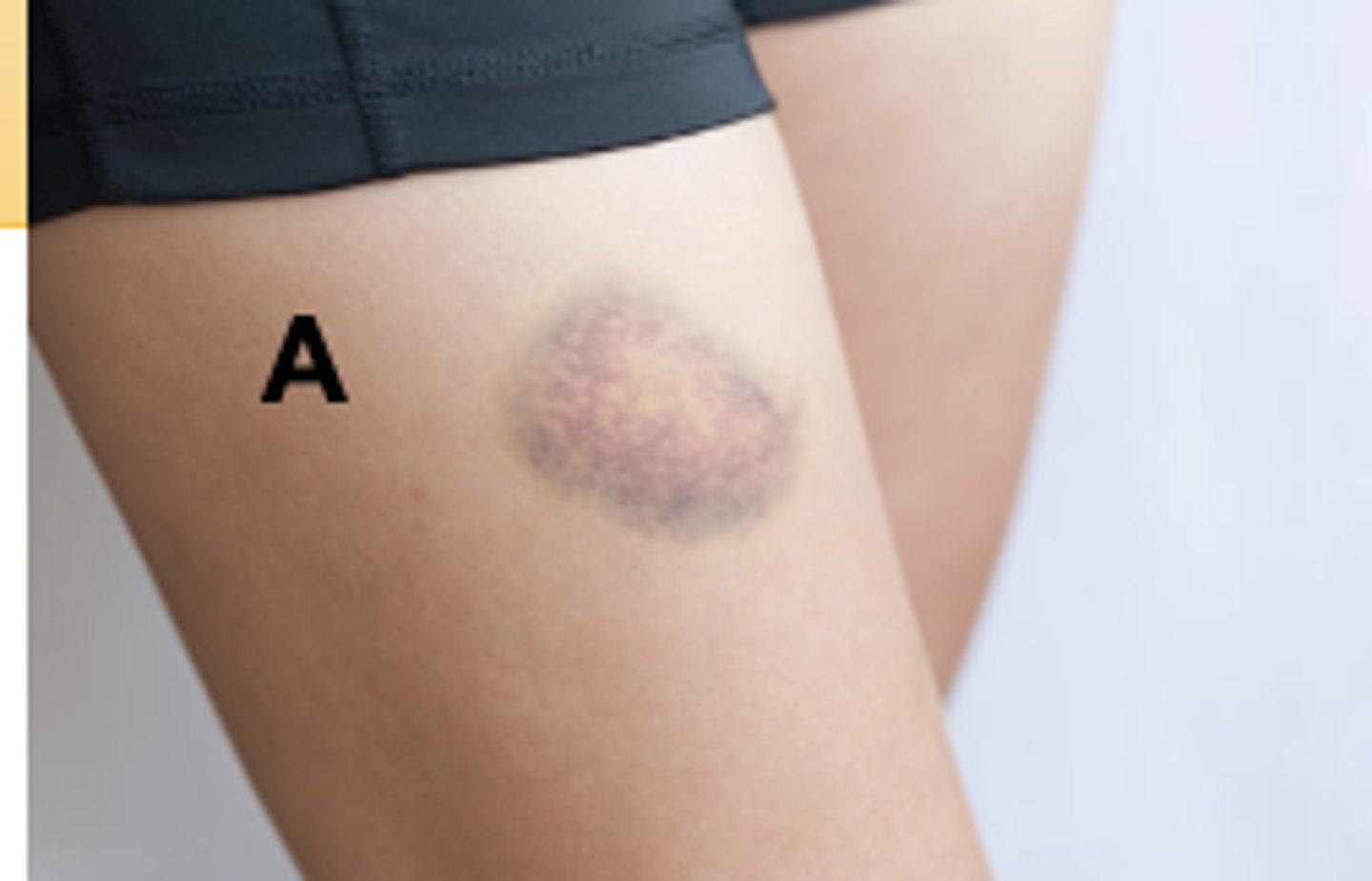 <p>Contusion</p>