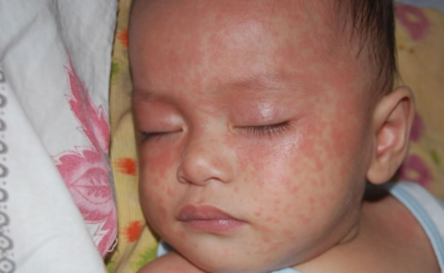 <p>in acquired infection of rubivirus the virus enters the _____. It then disseminates via _____ (2) to other tissues. A rash develops and the virus is shed from the ______</p>