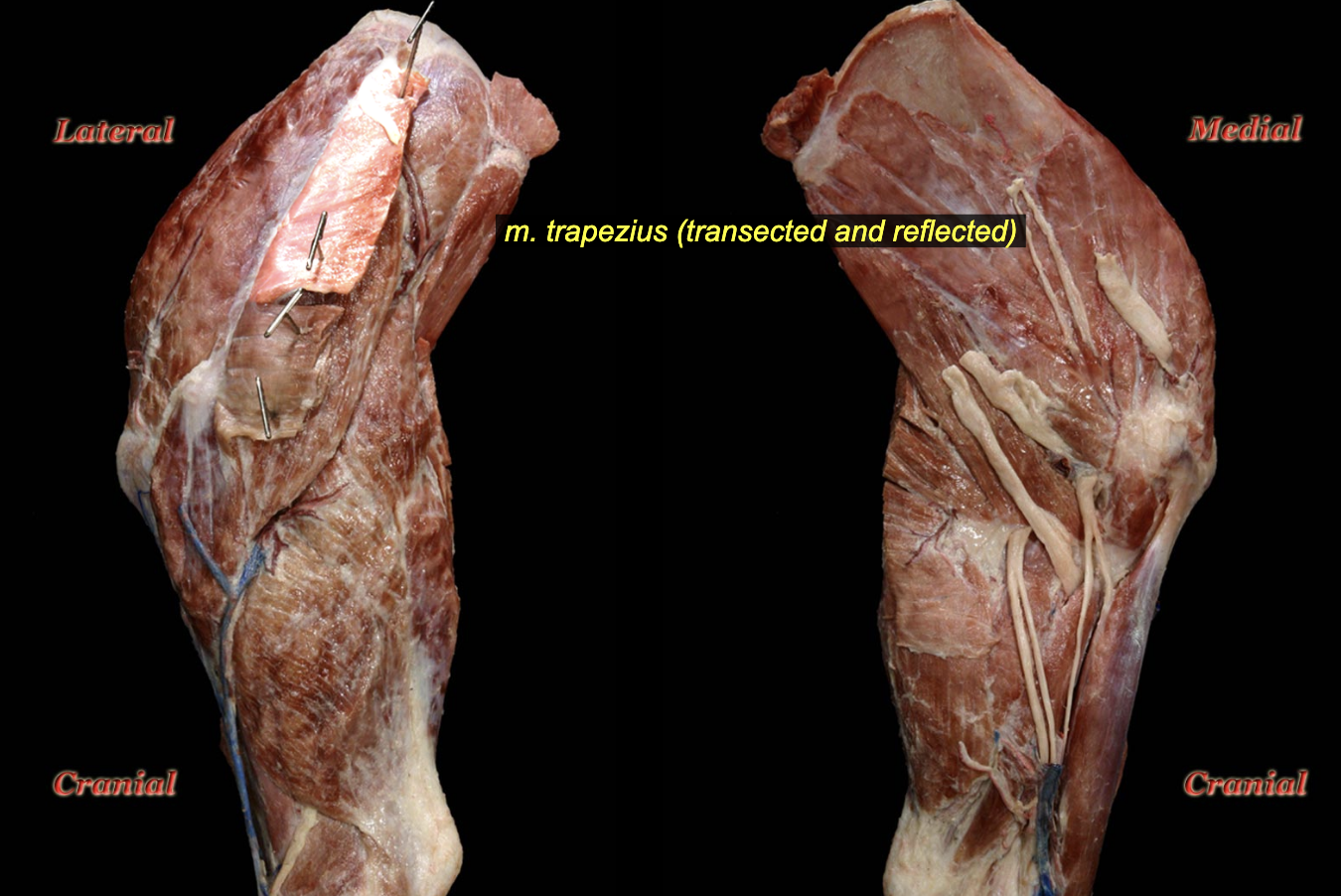 <p><span>O: Dorsal median raphe of neck and trunk (ca. C3 to T9)</span><br><span>I: Spine of scapula</span></p><p>N: Accessory n.<br><span>A: Elevation and abduction of thoracic limb</span></p>