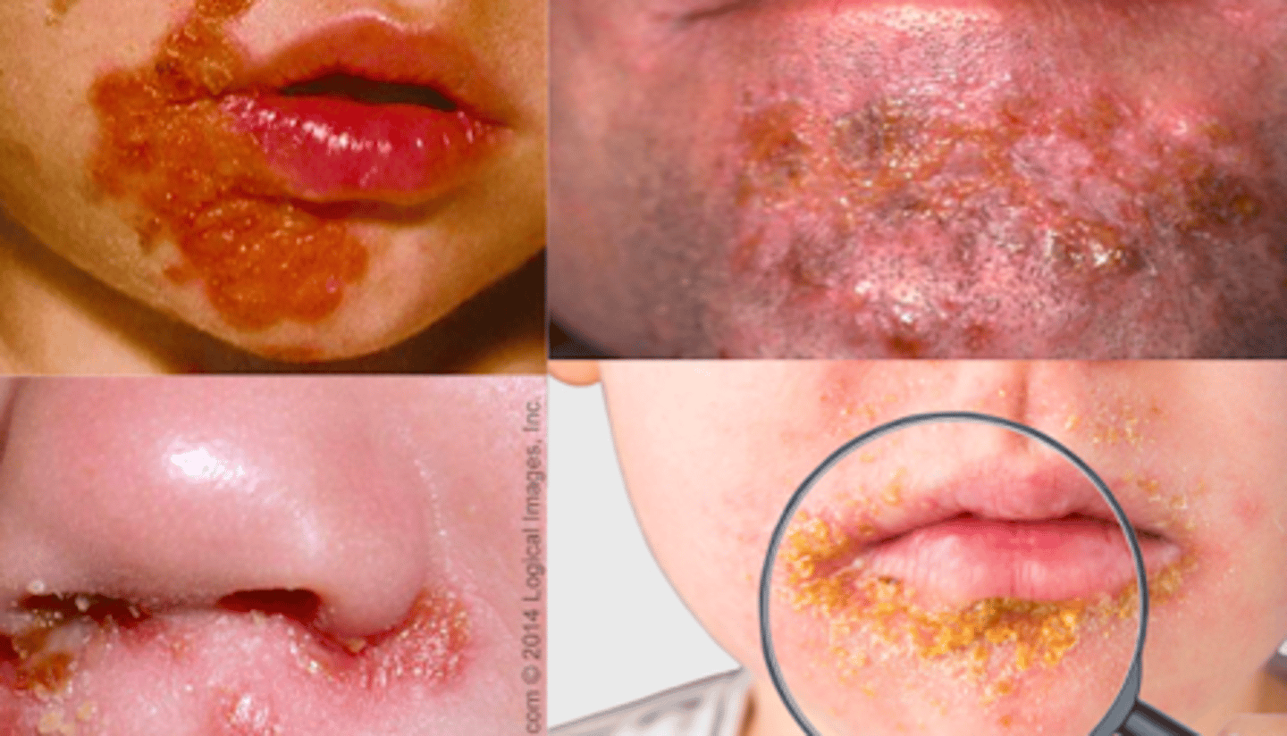 <p>Bacterial ID:</p><p>Symptoms:</p><p>- Begins with single erythematous macule</p><p>- Rapidly evolves into a vesicle or pustule and ruptures</p><p>- Released serous contents then dry, leaving a crusted, honey-colored exudate over the erosion (so if it says honey-colored crust - this is it!)</p><p>- Rapid spread may follow</p><p>- Face and extremities are affected most commonly (but can occur anywhere)</p><p>- May be pruritic</p><p>- Clusters in families and outbreaks in institutions are sometimes occasionally reported</p>