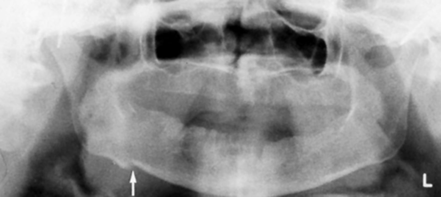 <p>What is the cause of this break seen in the image?</p>