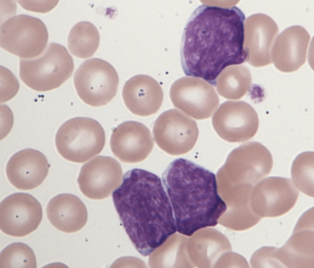 <p>which mature lymphoid neoplasm is associated with the following characteristics:</p><ul><li><p>small cell forms can be mistaken for CLL</p></li><li><p>blastoid variants can be mistaken for ALL</p></li><li><p>some morphologic changes can be confused with hairy cells or prolymphocytes </p></li></ul><p></p>