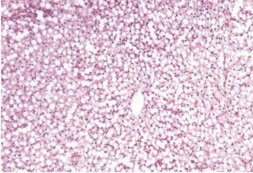 <p>Crisp, well defined lipid vacuoles that displace nucleus to edge of cell</p>