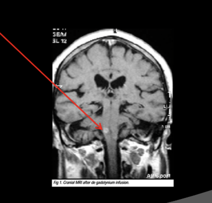 <p>Patients with lesions in the brain stem (medulla) have been reported to have uncontrolled crying (behavioral emotions)</p><ul><li><p>Not associated with “feeling” sad</p></li><li><p>Dissociation between brain areas that control behavior and the other components of emotion</p></li></ul><p></p>
