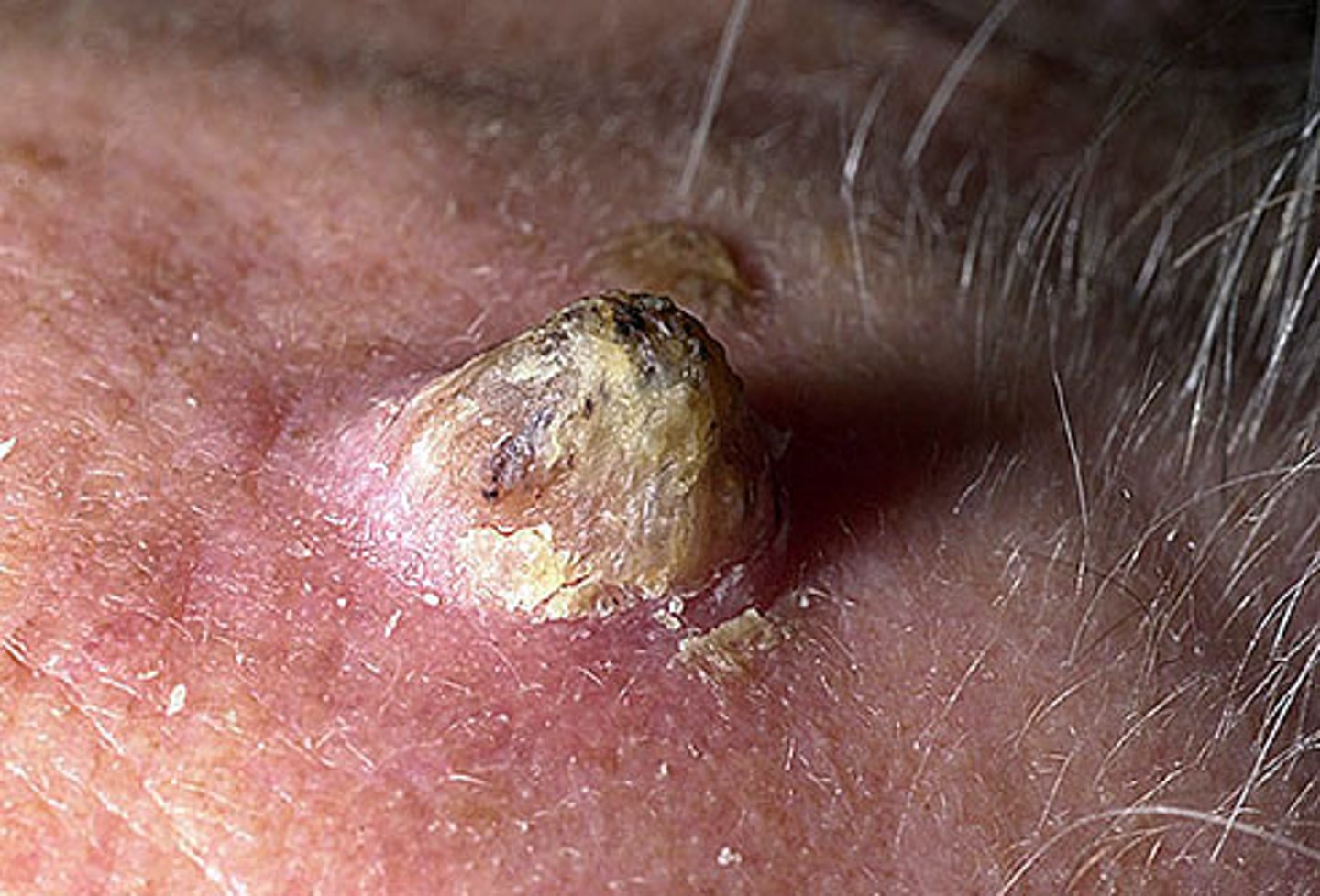 <p>Appearance of an animal horn w/ a papular or nodular base and a keratotic cap </p><p>Usually a SCC or SCC in situ at base of horn </p><p>Should be biopsied then removed surgically </p>