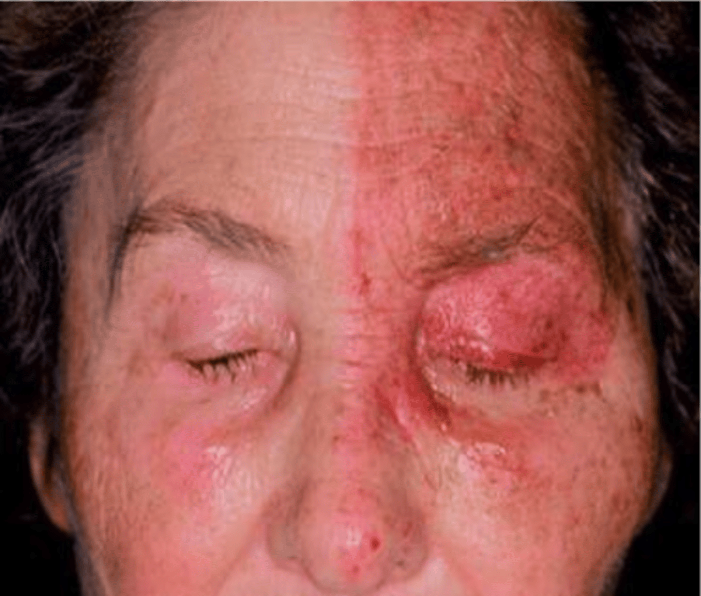 <p>AKA shingles</p><p>• HZV recurrent infection</p><p>• follows dermatome - never crosses midline</p><p>• vesicles</p><p>• extreme PAIN</p><p>• population: older adults above 60</p>