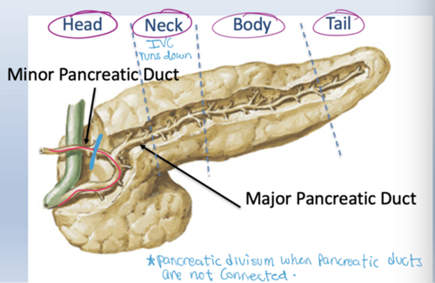 <p>The pancreatic ducts are not connected</p>