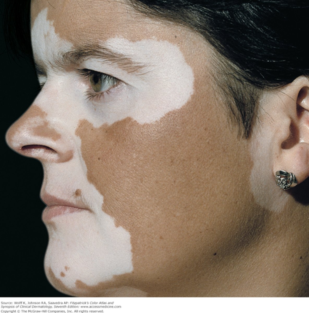 <p>depigmentation, clear demarcations (generalized, acral or acrofacial, localized, segmental)</p>