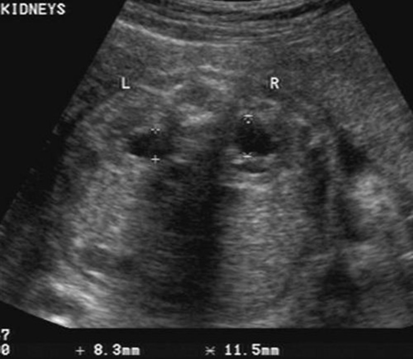 <p>Pelvis is > 10 mm</p><p>Few calyces seen</p><p>Cortex is normal</p>