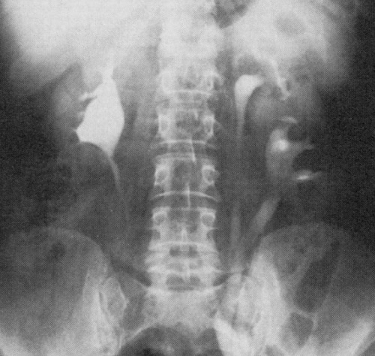 <p>What congenital anomaly occurs when the entire kidney is duplicated?</p>