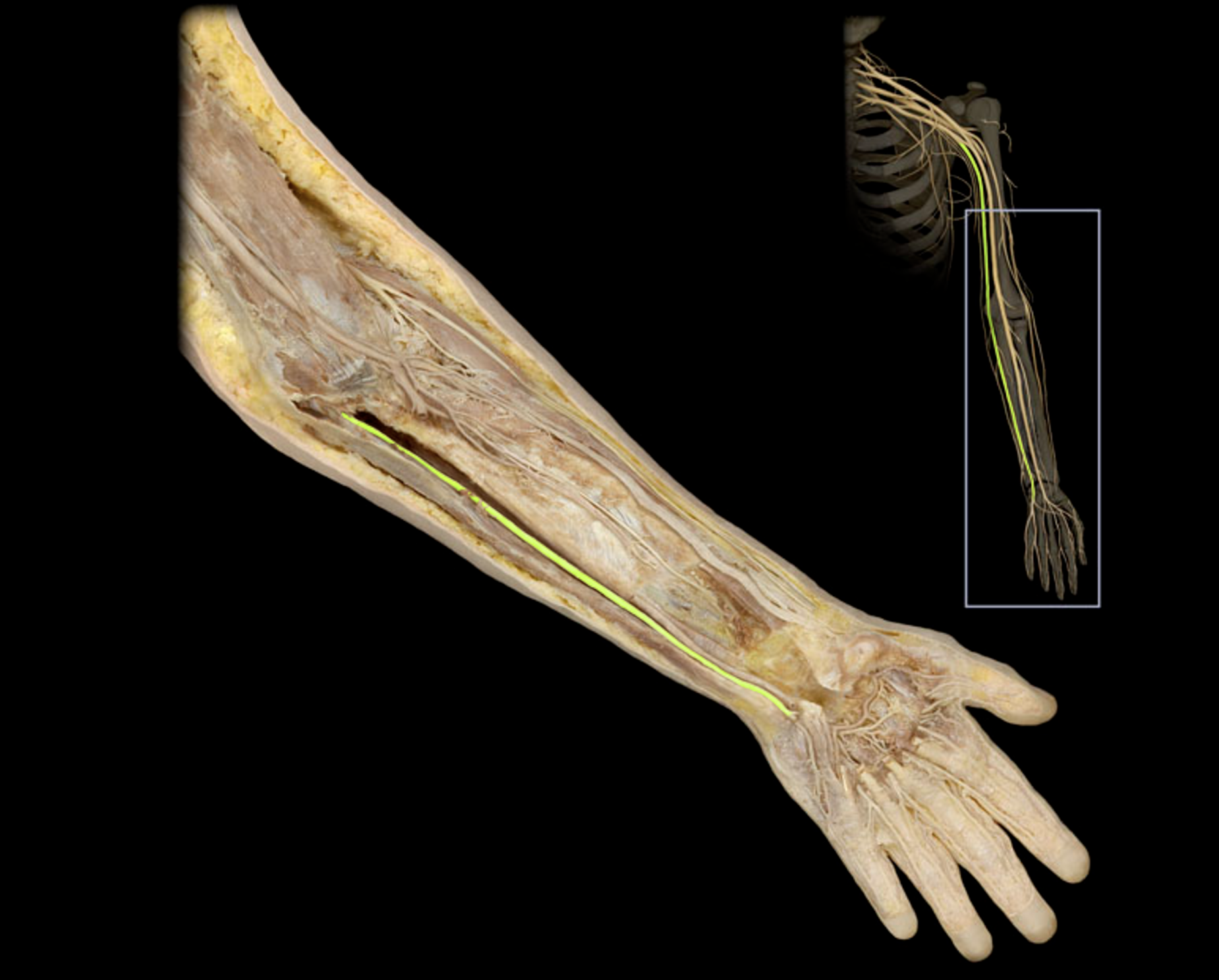 <p>A major nerve of the upper limb that innervates the muscles of the forearm and hand, particularly affecting the little finger and half of the ring finger. </p>