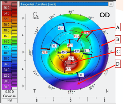 <p><span>Look at the attached topography. &nbsp;Which point is the FLATTEST in terms of the slope of the cornea?</span></p>