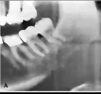 <p>wide zone of <strong>RADIOLUCENT</strong> transition with few or no trabeculae between lesion periphery and normal bone</p>