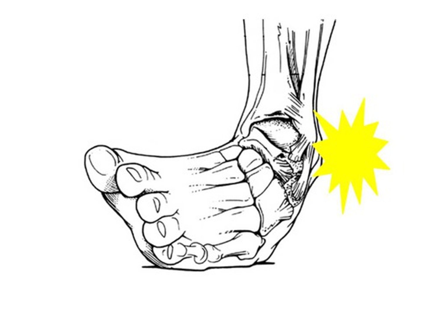 <p>to sprain an ankle</p>
