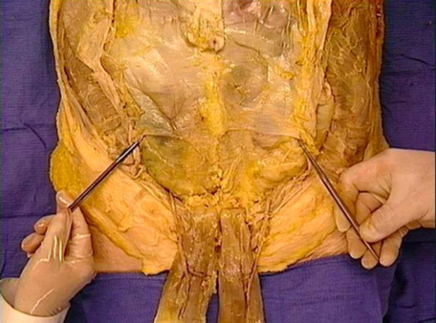 <p>a ridge of bone that runs inferiorly and anteriorly from the auricular surface</p>