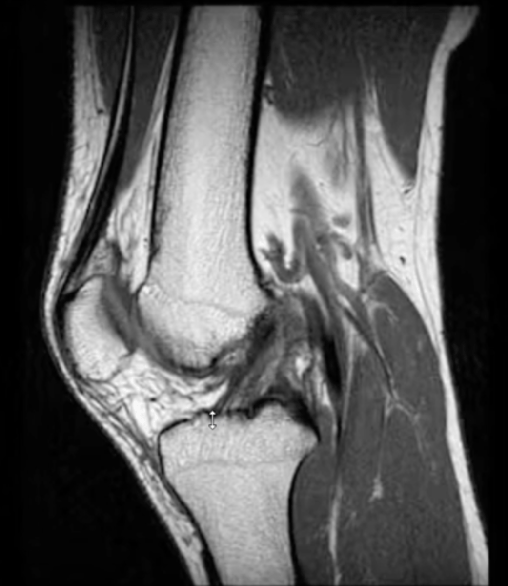 <p>Which ligament can you see in this sagittal view?</p>