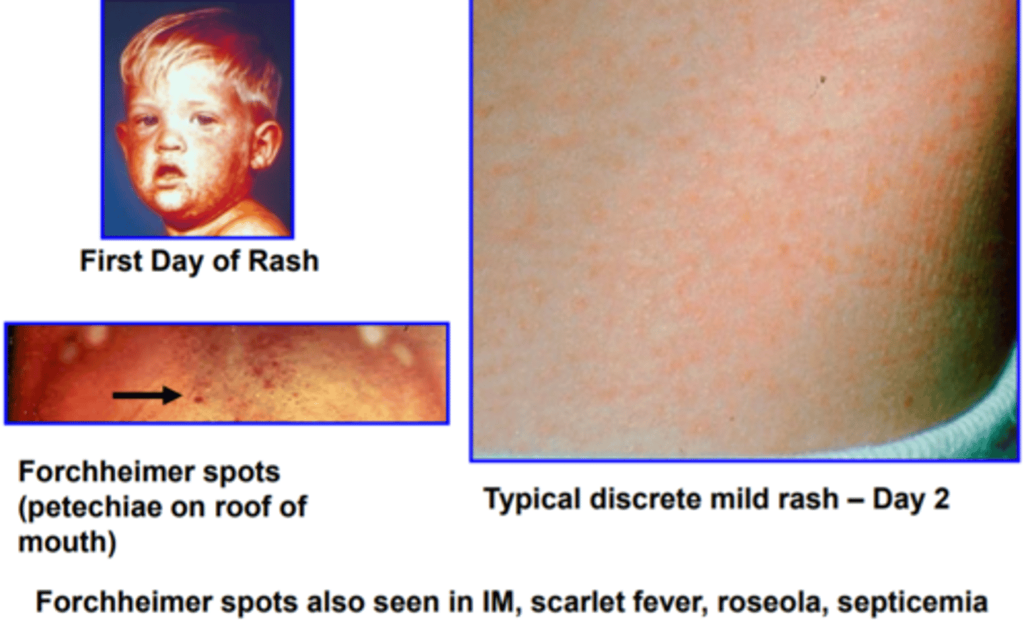<p>Pink rash starts on face and spreads down, milder than measles</p><p>joint pain</p><p>Droplet Precautions for a week</p>