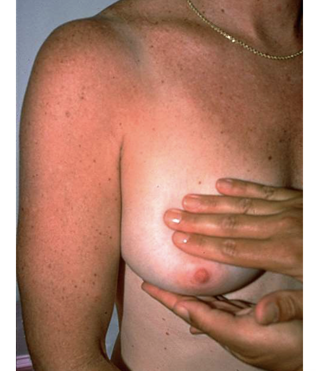 <ul><li><p>specially helpful with large pendulous mammary tissue </p></li><li><p>also helpful to further characterize a lump if not felt well in the supine position </p></li></ul><p></p>