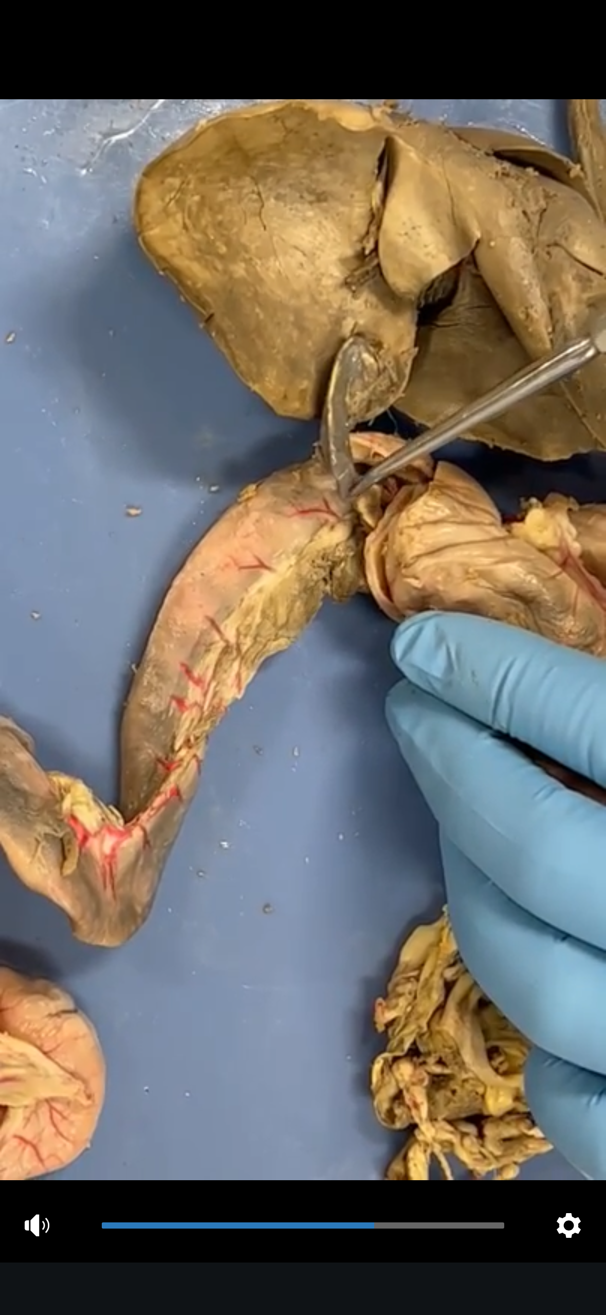 <p>Cystic Duct</p>