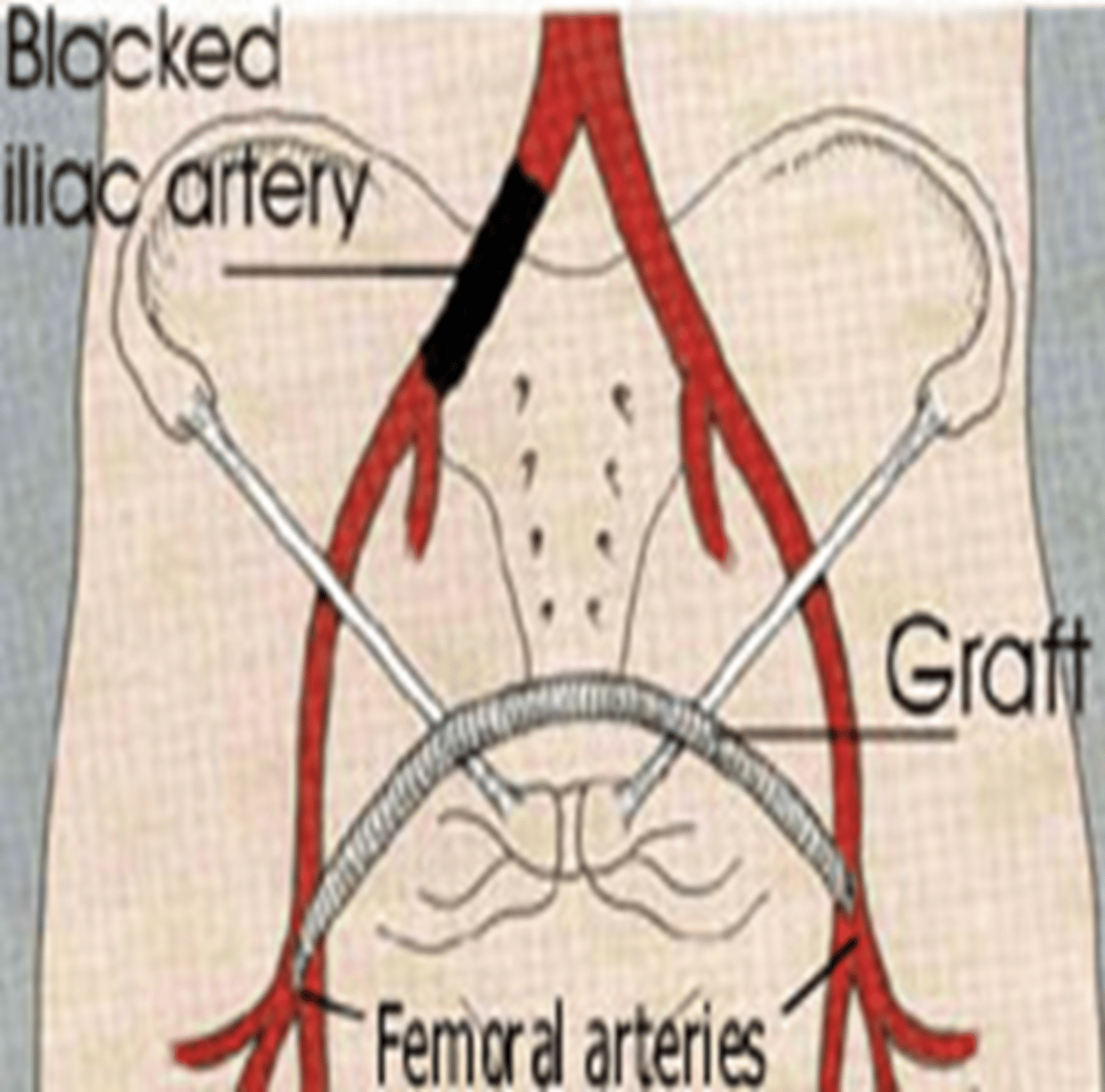 <p>Bypasses single iliac artery</p><p>Scar in each groin</p>