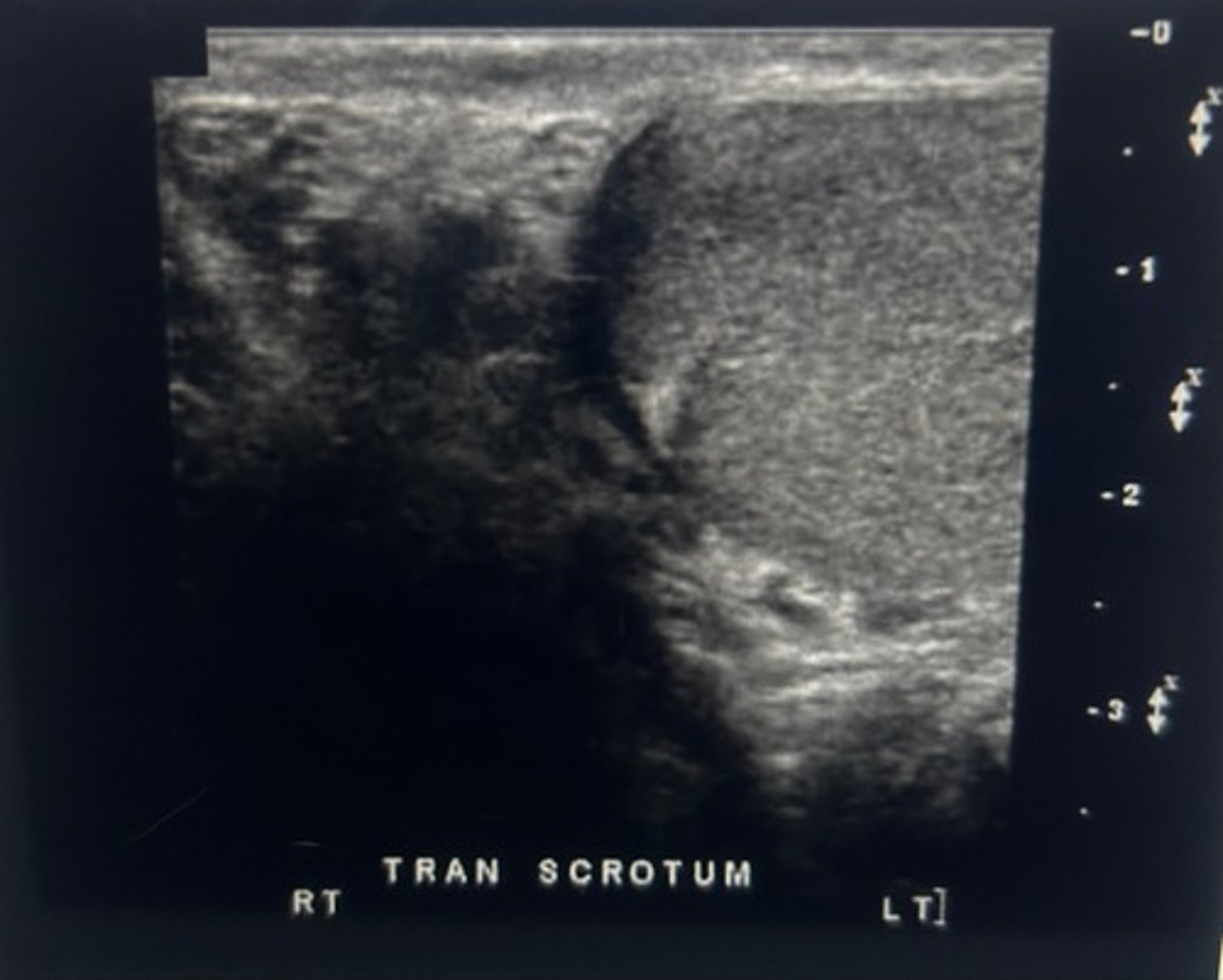 <p>Evaluate the right groin for an on the undescended testicle</p><p>The testicles form in the lower pelvic region and migrate to the scrotal sac after 36 weeks of gestational age. When the scrotal sac is found to contain only one testicle, the undescended testes is most commonly found along the inguinal canal of the affected side.</p>