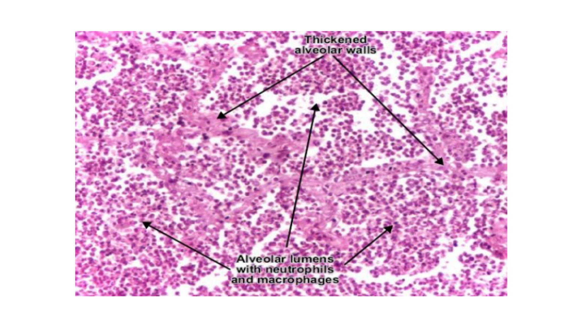 <p>Lobar Pneumonia</p>