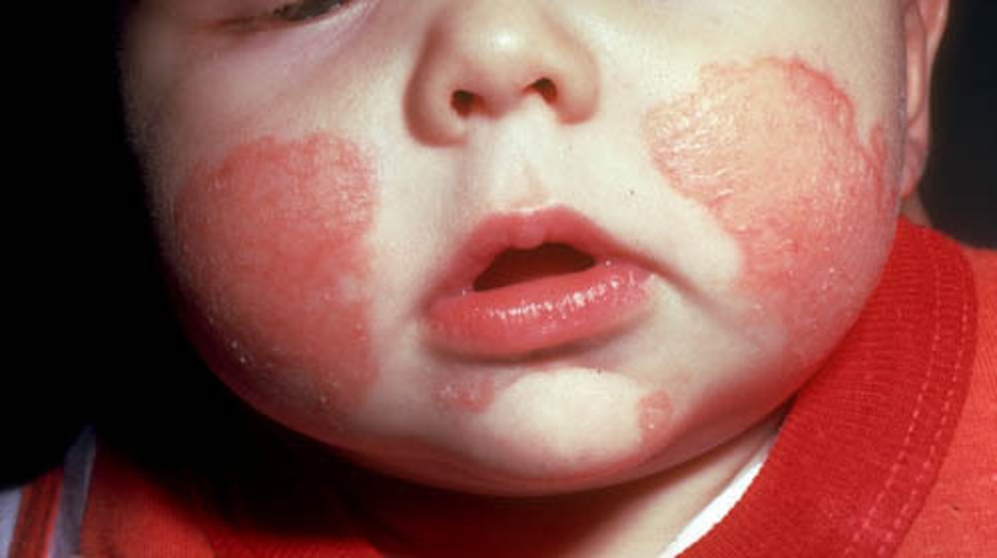 <p>an inflammatory, painful itching disease of the skin that can be acute or chronic in nature with dry or moist lesions</p>