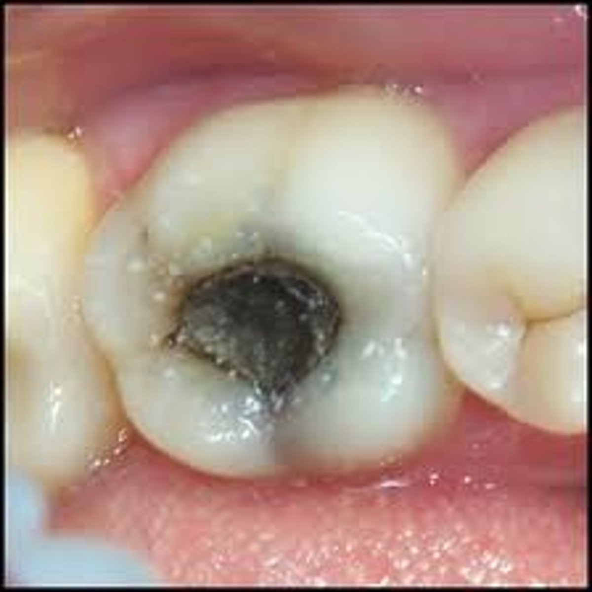 <p>a coating of bacteria and food on teeth, the bacteria respiring sugars in the food, producing acid which dissolves the enamel and dentine</p>