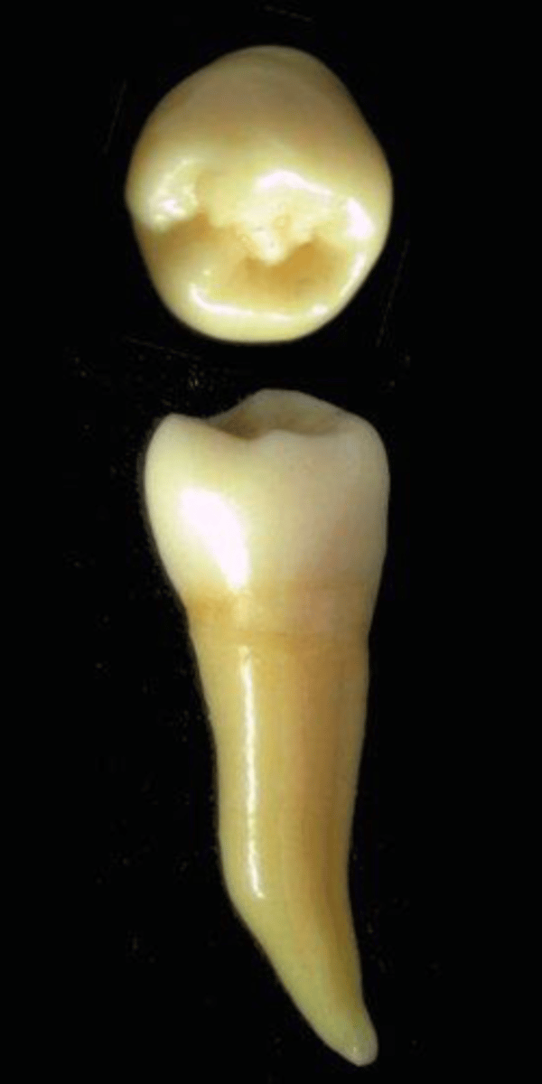 <p>what tooth is this &amp; why?</p>
