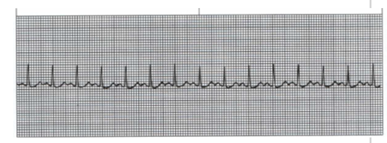 <p>What is the HR displayed here and what would it be classified as?</p><p>A. 15 bpm-bradycardia</p><p class="p2">B. 150 bpm-tachycardia</p><p class="p1">C. 90 bpm-tachycardia</p><p class="p1">D. 150 bpm-bradycardia</p>