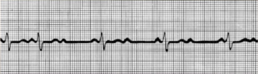 <p>AV node fails to conduct some SA node impulses</p><p>~2 P waves per 1 QRS complex</p>