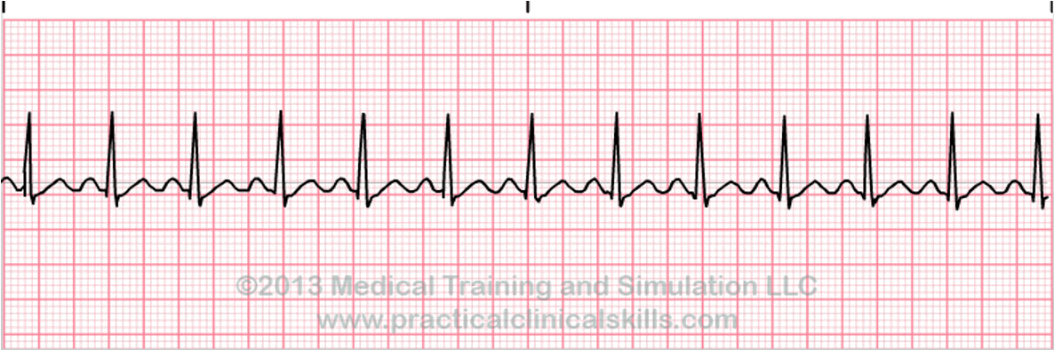 <p>HR:&gt;100 bpm</p><p>P-wave:1 per QRS complex</p><p>Regularity:regular</p><p>PR Interval:Normal</p><p>QRS Duration:Normal</p><p></p>