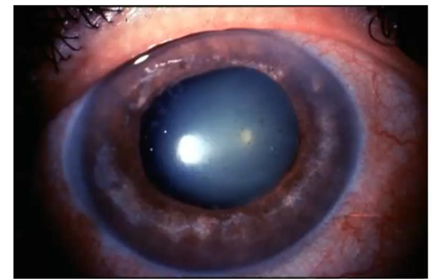 <p>mydriatic pupil : acute angle close glaucoma </p>