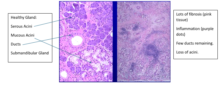<p>Obstruction of duct → saliva retention and inflammation of gland</p><p>Swelling and fibrosis of gland → damage acini → reduce saliva production</p><p>Fibrosis → leads to irreversible loss of function</p>