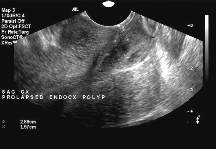 <ul><li><p>Attached by a stalk to cervical wall</p></li><li><p>May be difficult to see on US due to size</p></li><li><p>“teardrop” appearance</p></li></ul><p></p>