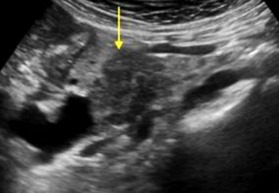 <p>Sonographic appearance: adenocarcinoma</p>