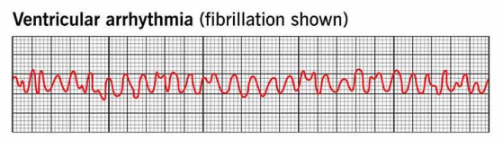 Rapid, irregular contractions. This causes the heart to become useless for pumping blood, thus causing circulation to cease and can lead to brain death.
