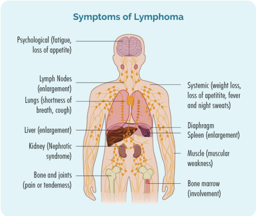 <p>Symtombilden är olika för olika lymfom, ibland kan det vara asymptomatiskt. Generella symptom är följande:</p><ul><li><p><strong>Lymfadenopati</strong>: Förstorade, rörliga och oömma lymfnoder. Kan ge olika symptom såsom tryckkänsla → beroende på var de är.</p></li><li><p><strong>B-symptom</strong>: Karaktäristiskt för lymfom. Uppstår pga mycket <em>cytokiner</em>, trycks undan av kortisol under dagen.</p><ul><li><p>Nattliga svettningar</p></li><li><p>Viktnedgång</p></li><li><p>Feber</p></li></ul></li><li><p><strong>Splenomegali</strong></p></li><li><p><strong>Trötthet</strong></p></li><li><p><strong>Hudmanifestationer</strong>: klåda.</p></li></ul>