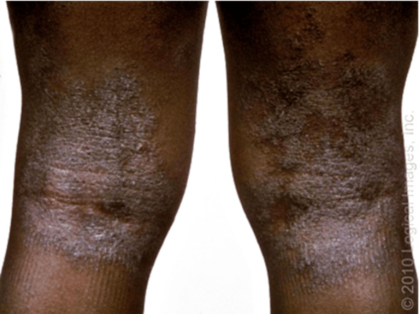 <p>Thickening and roughening of the skin with increased visibility of the normal skin furrows</p><p>- Ex: atopic dermatitis</p>