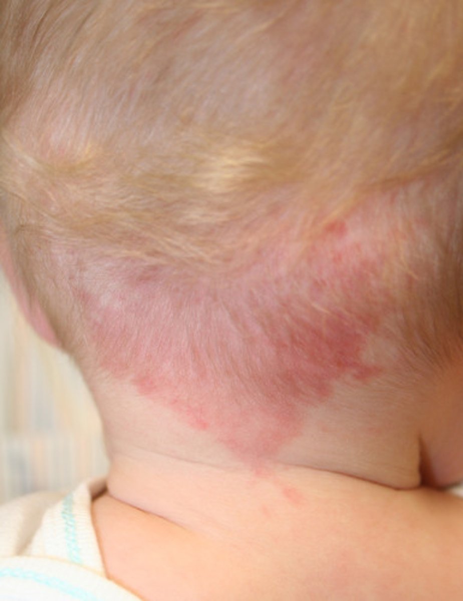 <p>FLAT PINK and RED PATCHES that are caused by a cluster of capillaries that usually appears on the back of the neck or head. These are harmless and fade over time usually by age 2.</p>