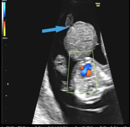 <p>an abd wall defect where the abd contents herniate <strong>into the base of umbilical cord</strong> is called</p><p>a) allantoic cyst</p><p>b) omphalocele</p><p>c) gastroschisis</p><p>d) marginal cord insertion</p>