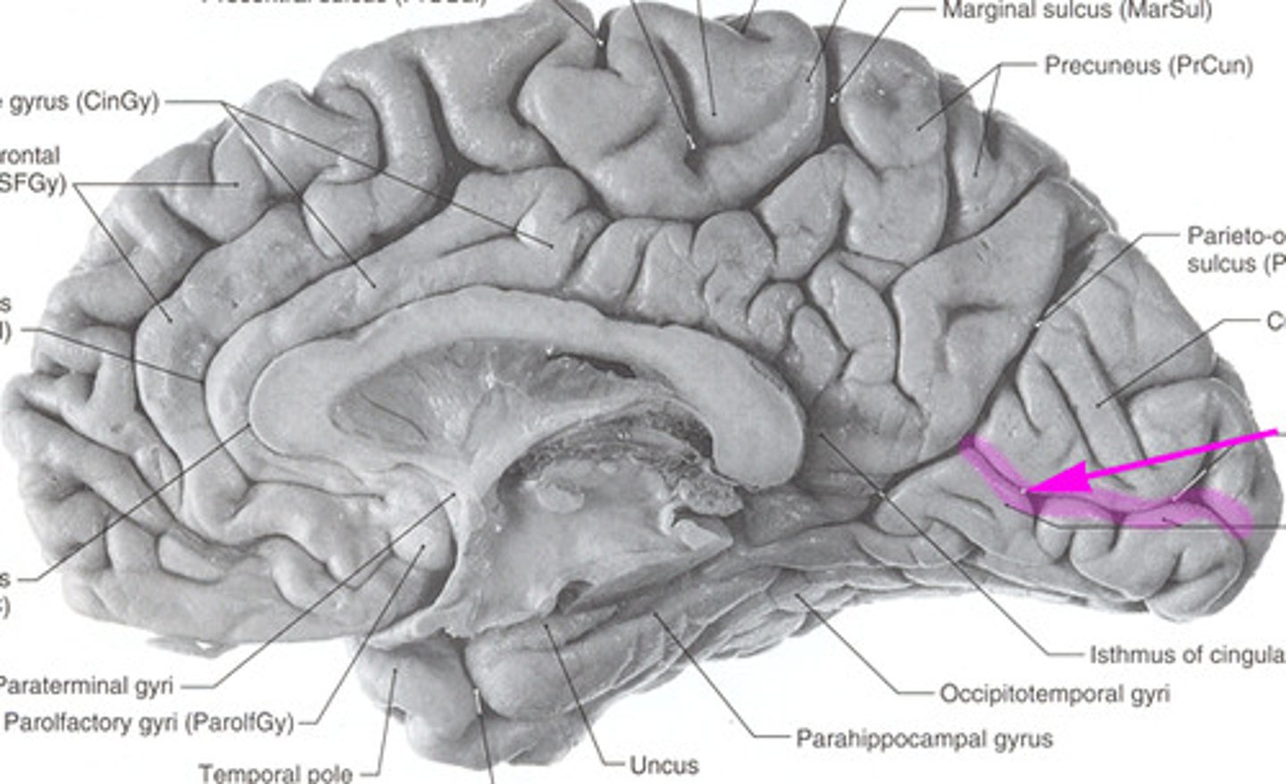 <p>either side of calcarine sulcus</p>